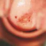 Τυπικη εικονα προσβολής από HPV